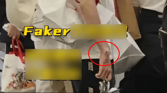 Faker Shows Signs of Severe Varicose Veins